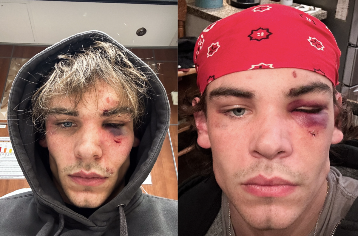 Kentucky Kernel TikTok Manager Bryce Towle's injuries after assault off-campus. 